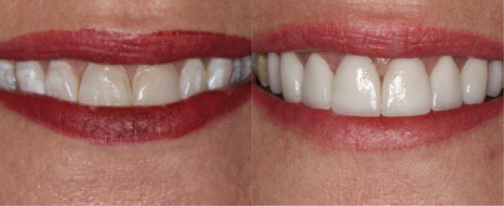This patient had 8 porcelain veneers to fix some color issues with her teeth.