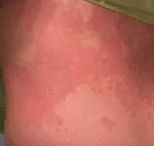 Here is a picture of what my sensitization looked like after inhaling lemongrass when formulating for my client.