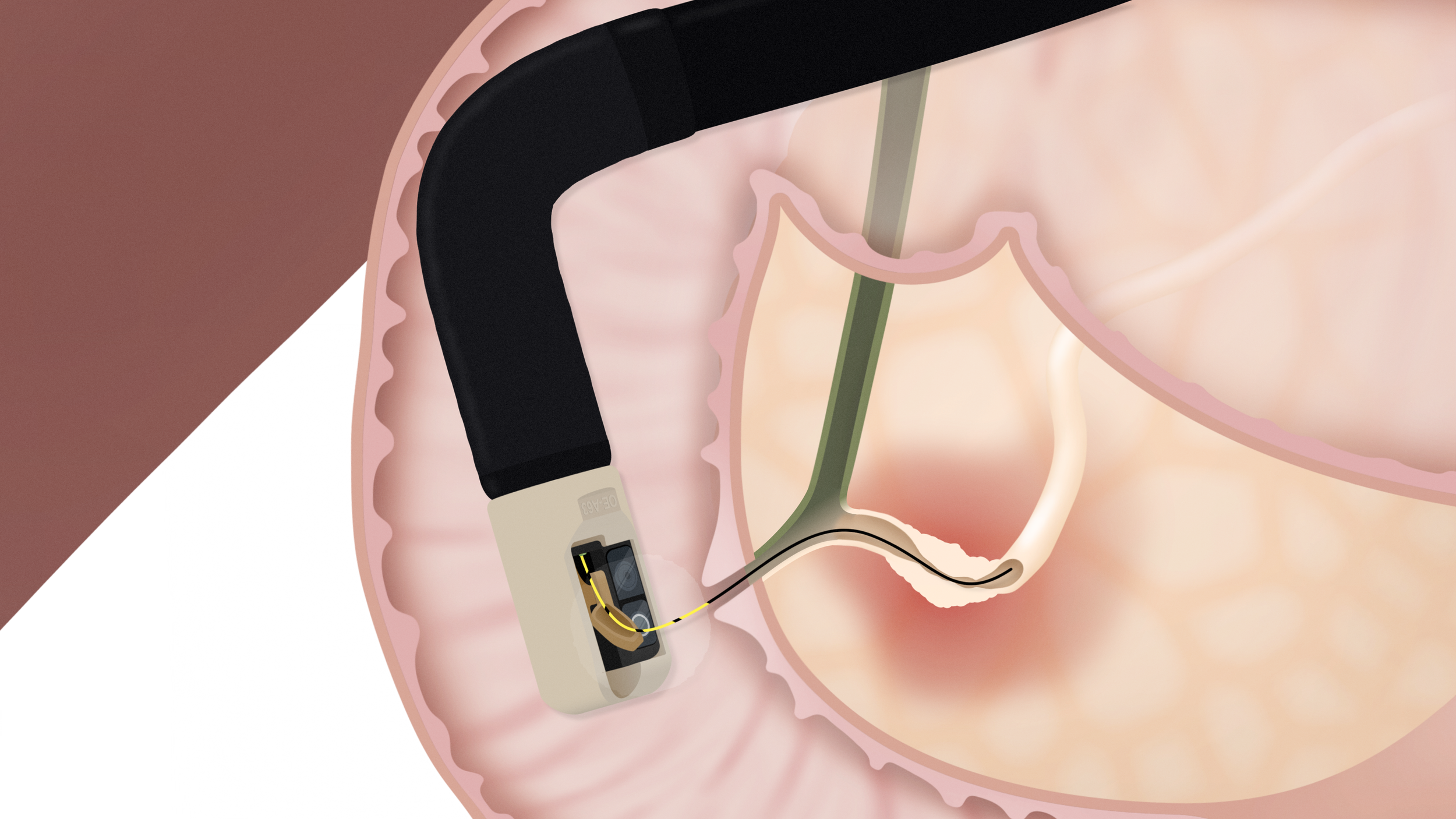 pancreatic duct stricture V1.png