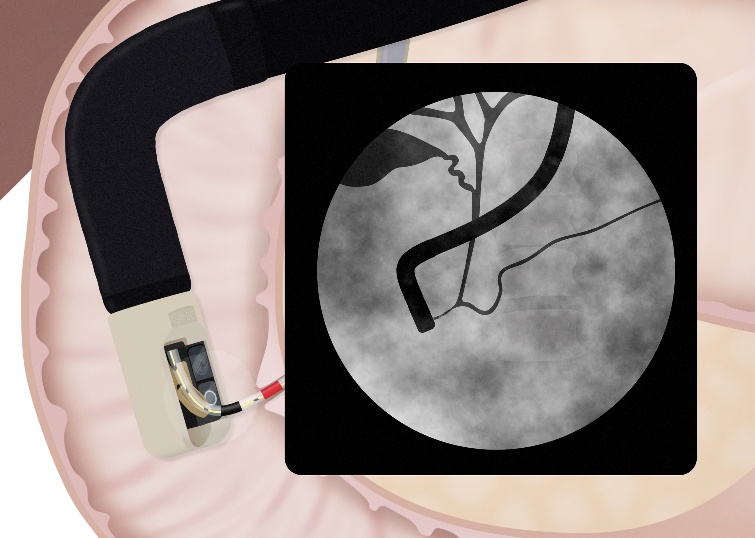 PENTAX - Endoscope - Contrast Dye.png