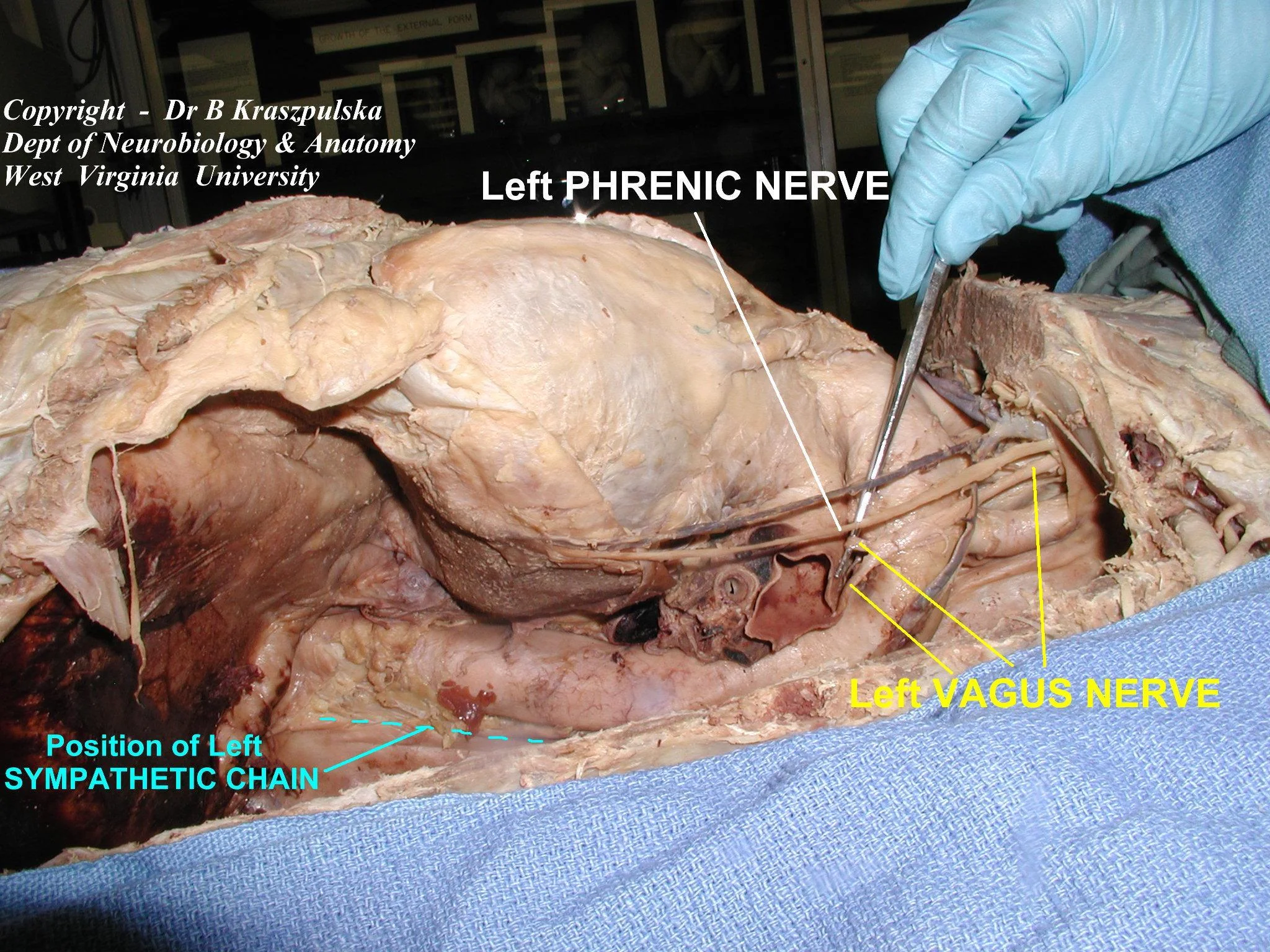 phrenic vagal nerves cadaver