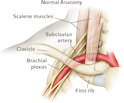 ThoracicOutletSyndrome