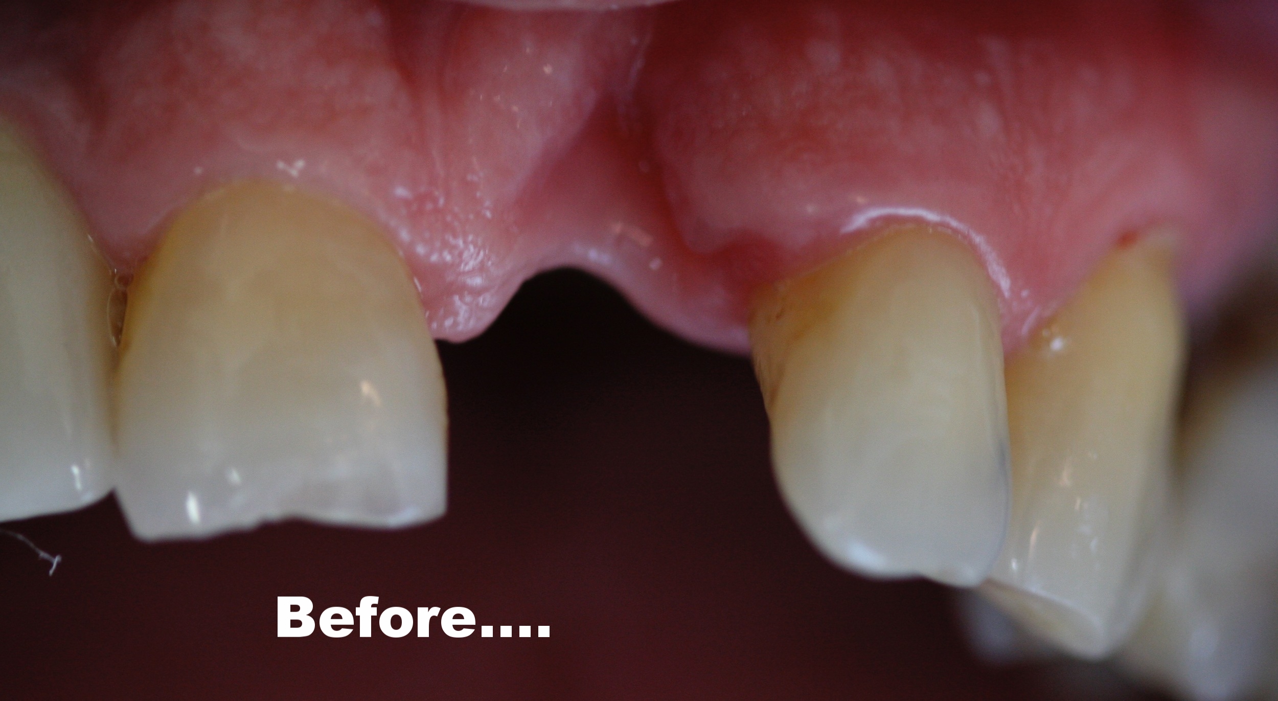 1) Lost tooth, inadequate supporting bone..