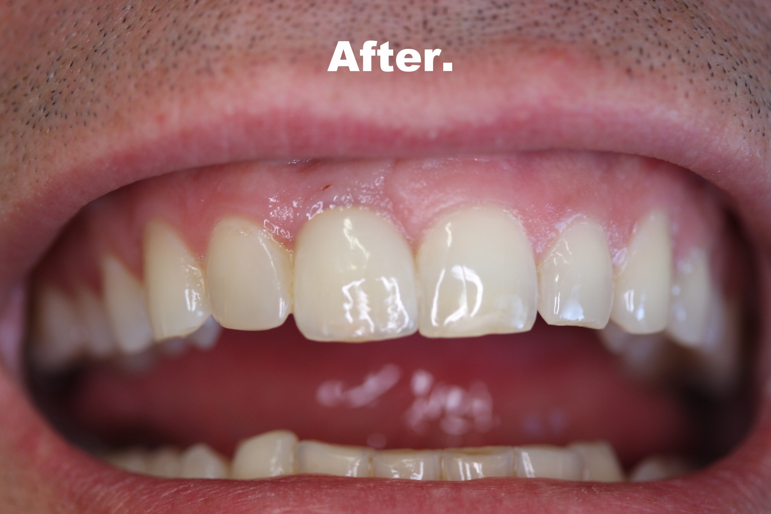 6)...replaced with aesthetic crown + implant