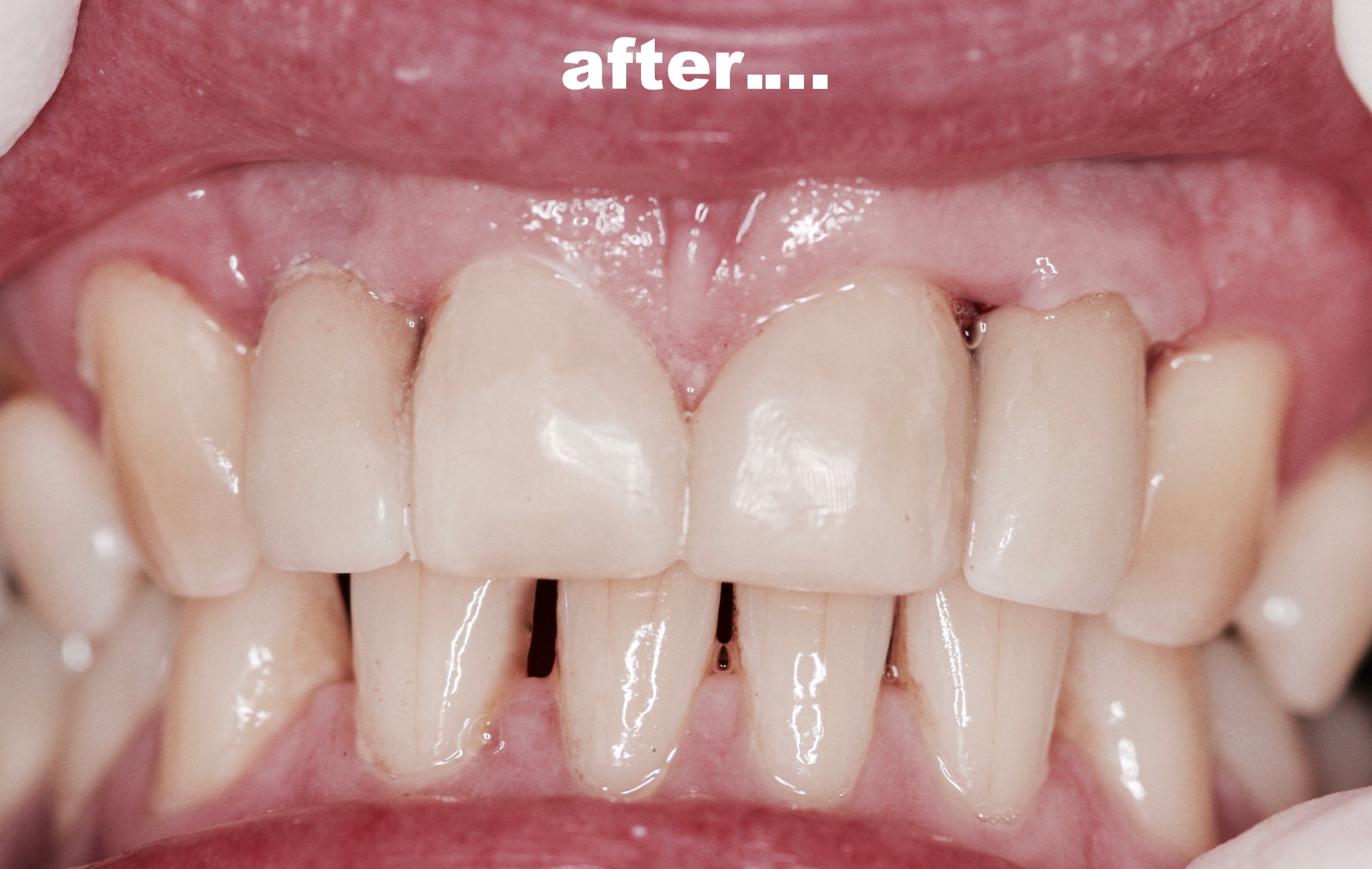 4) ...Replaced with 2 implants, crowns and veneers