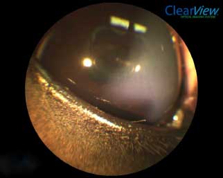 ClearView ophthalmic photograph