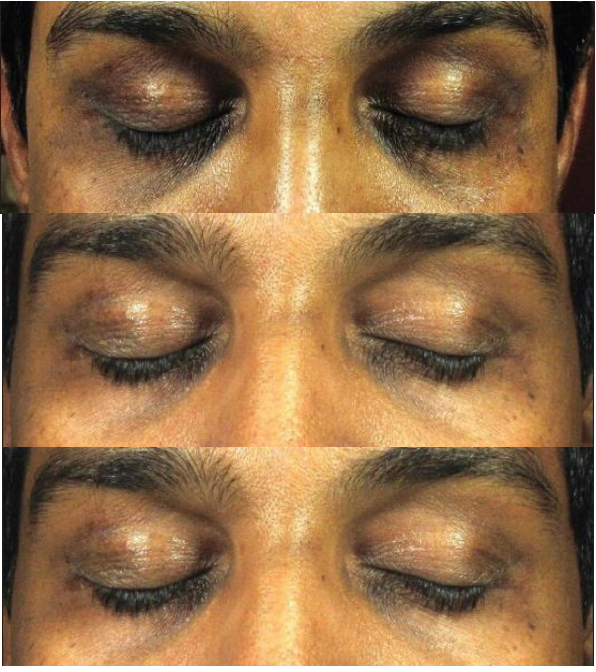 microneedling mayfair