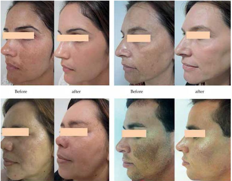 microneedling mayfair