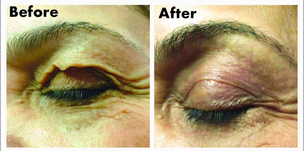 Blepharoplasty_6.jpeg