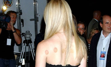 Cupping Therapy