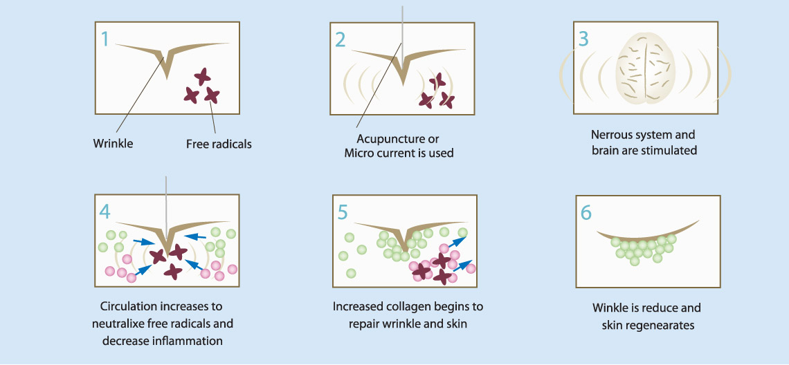 This happens because the acupuncture stimulates the nervous, hormonal and circulatory systems to boost collagen and elastin production.