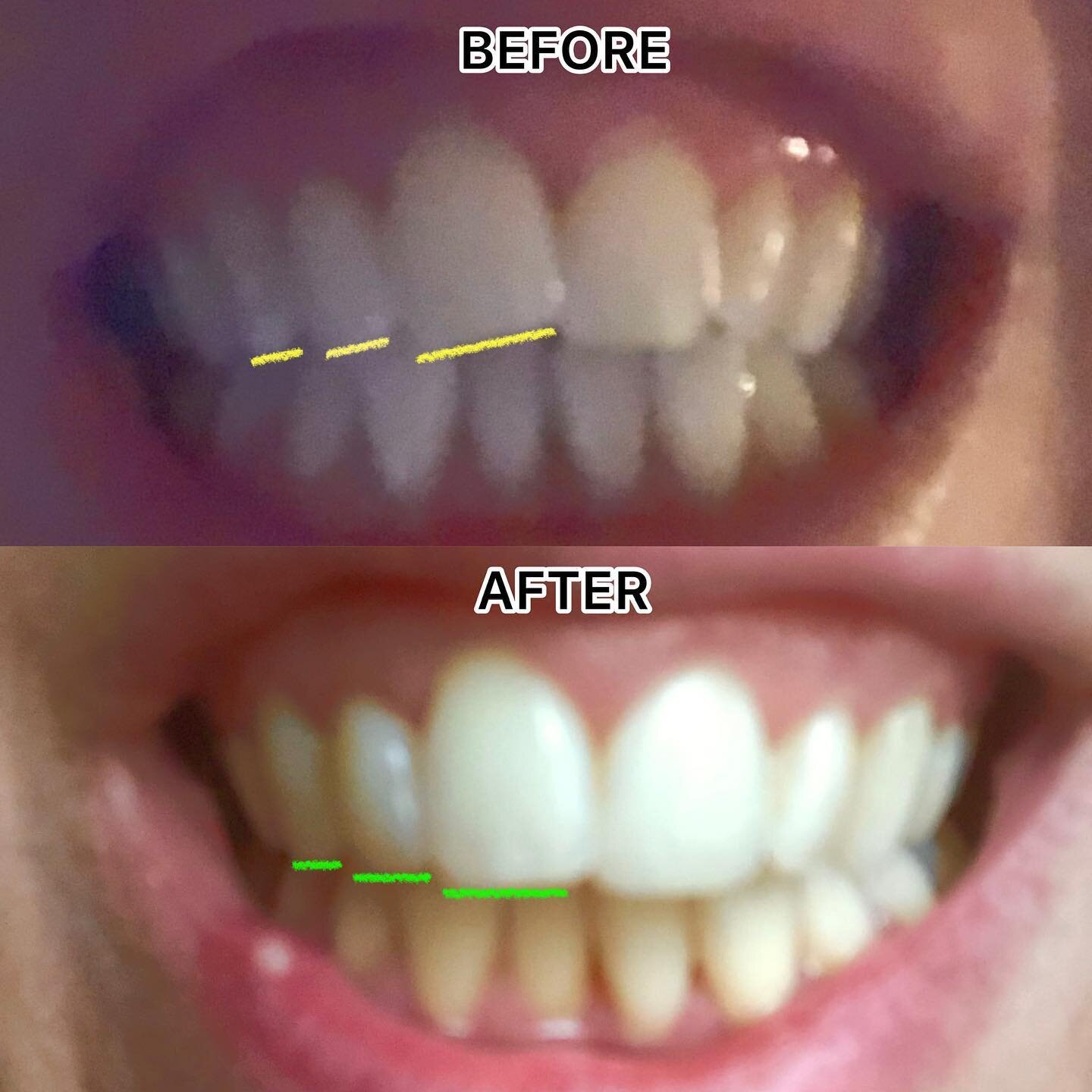 Teaching my clients the concept and position of neutrality from an asymmetric body is one of the most satisfying parts of my job. The right central incisor, lateral incisor and canine (underlined in yellow and green) went from a supinated or internal