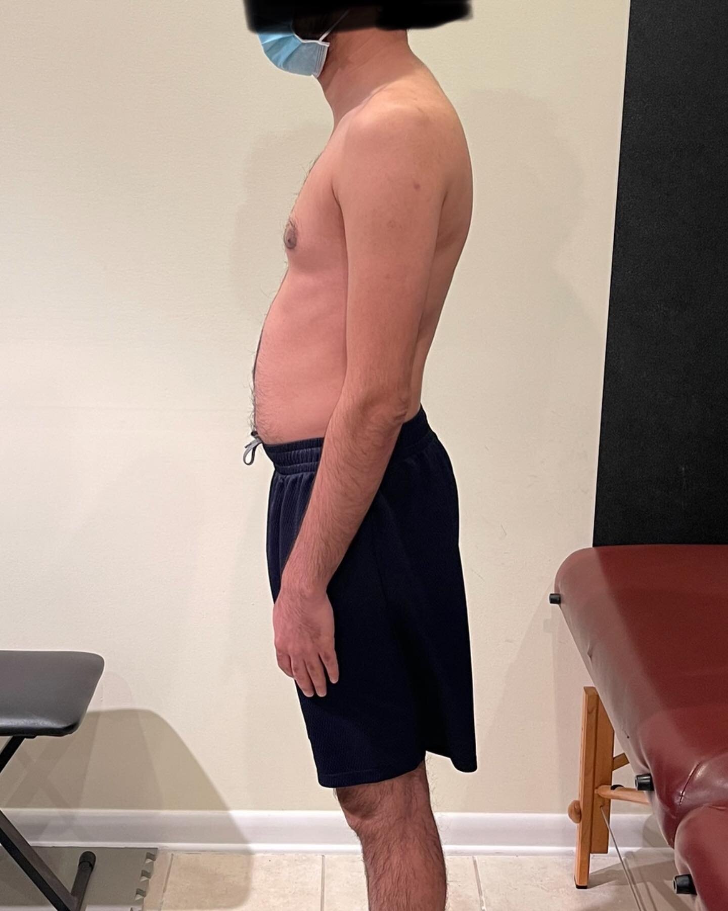 How drastically can your posture change with physical therapy? This took only 3 months of postural training and breath work to reposition his diaphragm and pelvic floor. Instead of breathing in through only his stomach, he is now able to expand his e