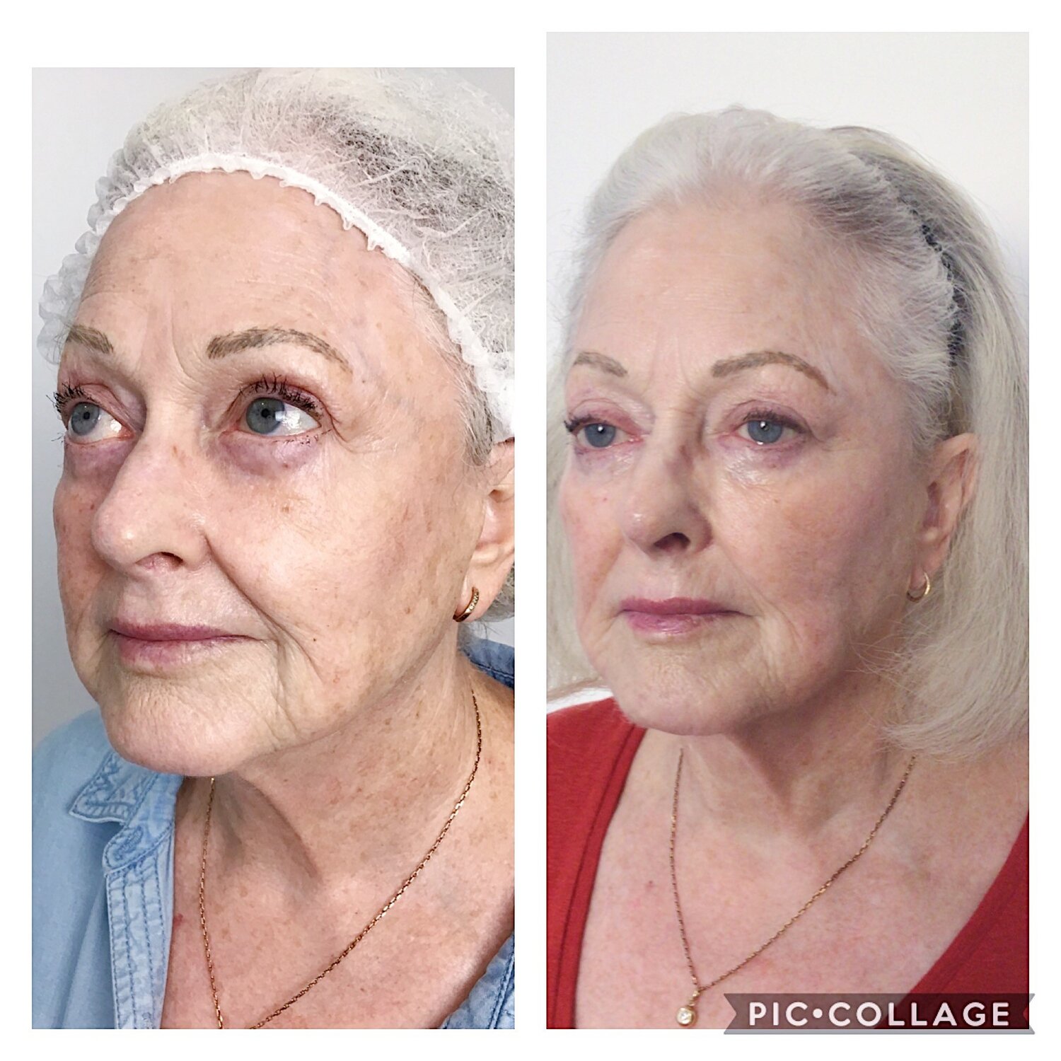 fundal de slăbire botox perth
