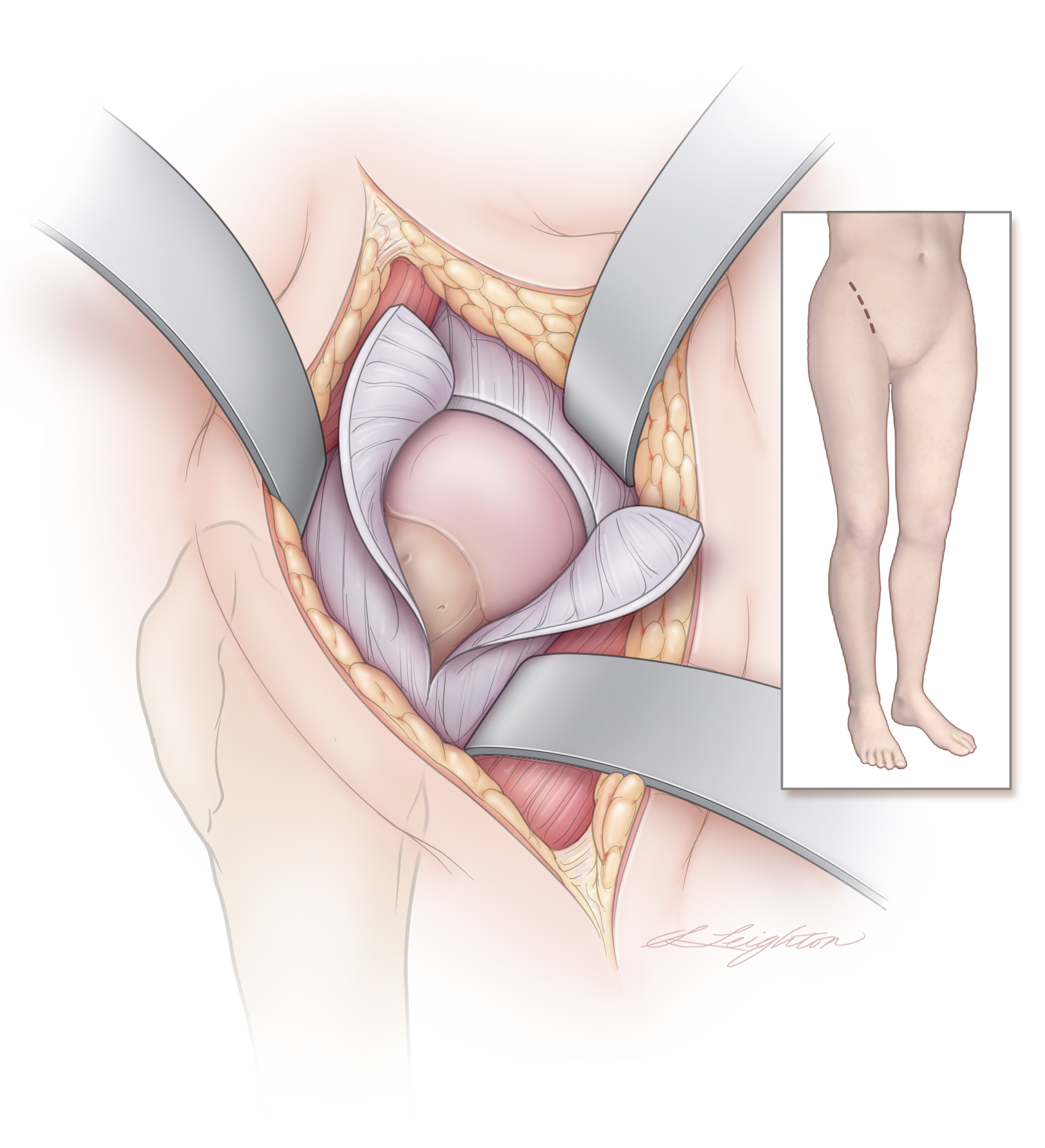 HipReplacement_Final.jpg