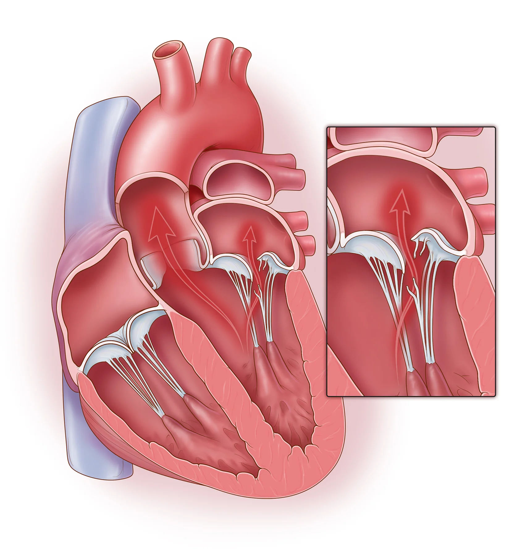 MitralValve_Proplapse_Final.jpg
