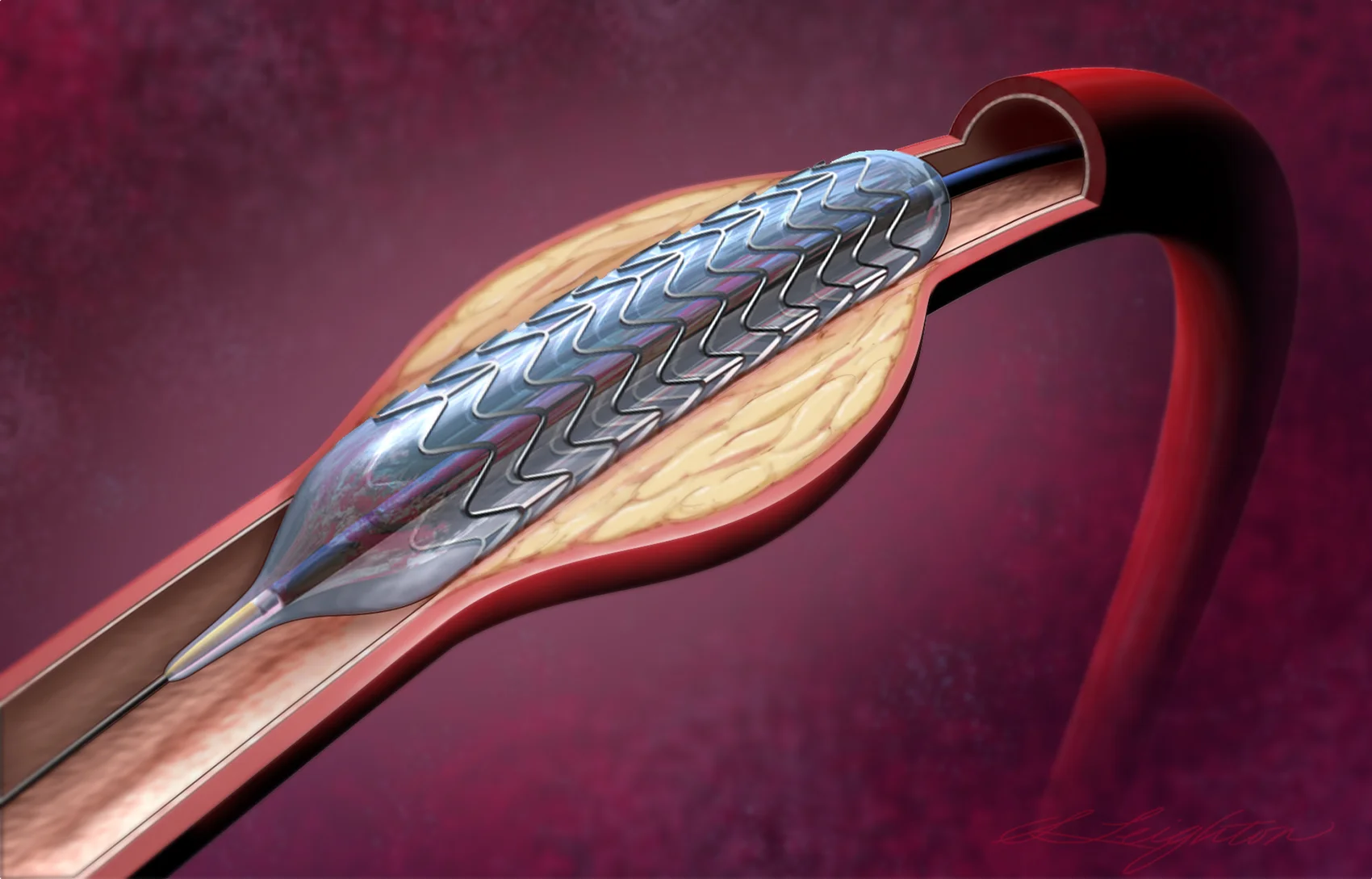 BalloonAngioplasty_Final.jpg