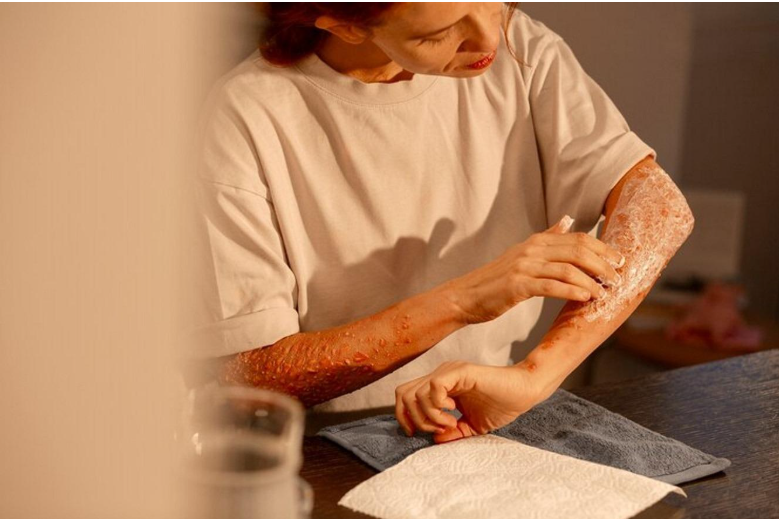 Does Homeopathy Offer Relief for Chronic Skin Conditions?
