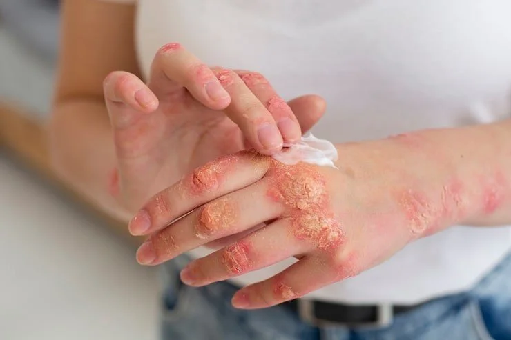 Homeopathy and Chronic Skin Conditions: Eczema, Psoriasis, and Urticaria