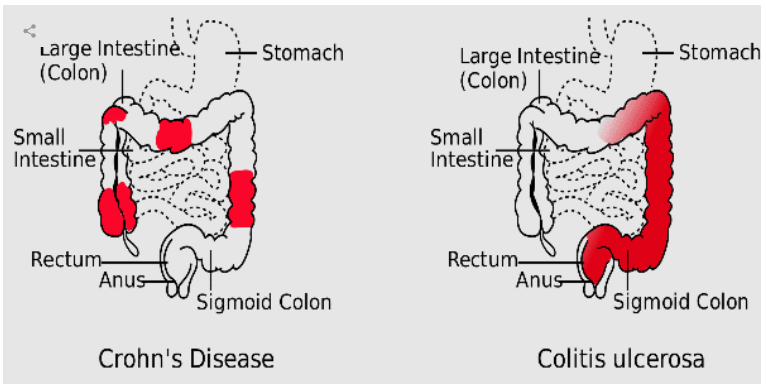 Low Dose Naltrexone Applications In Crohn S Disease Medicine Center Pharmacy