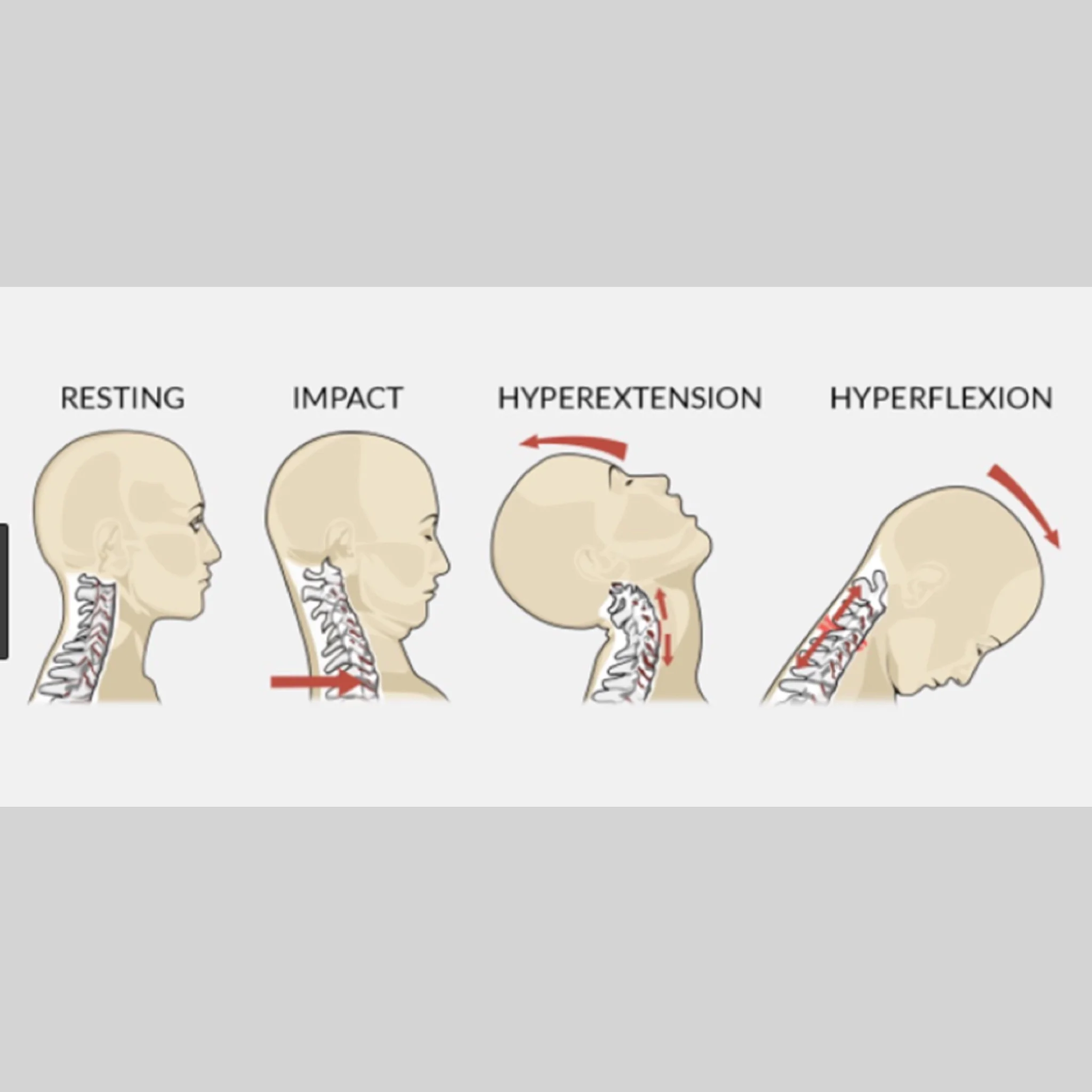 The Body Series - Neck - Whiplash