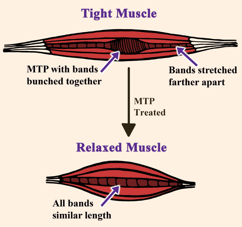 Why Your Muscles Keep Tightening Back Up