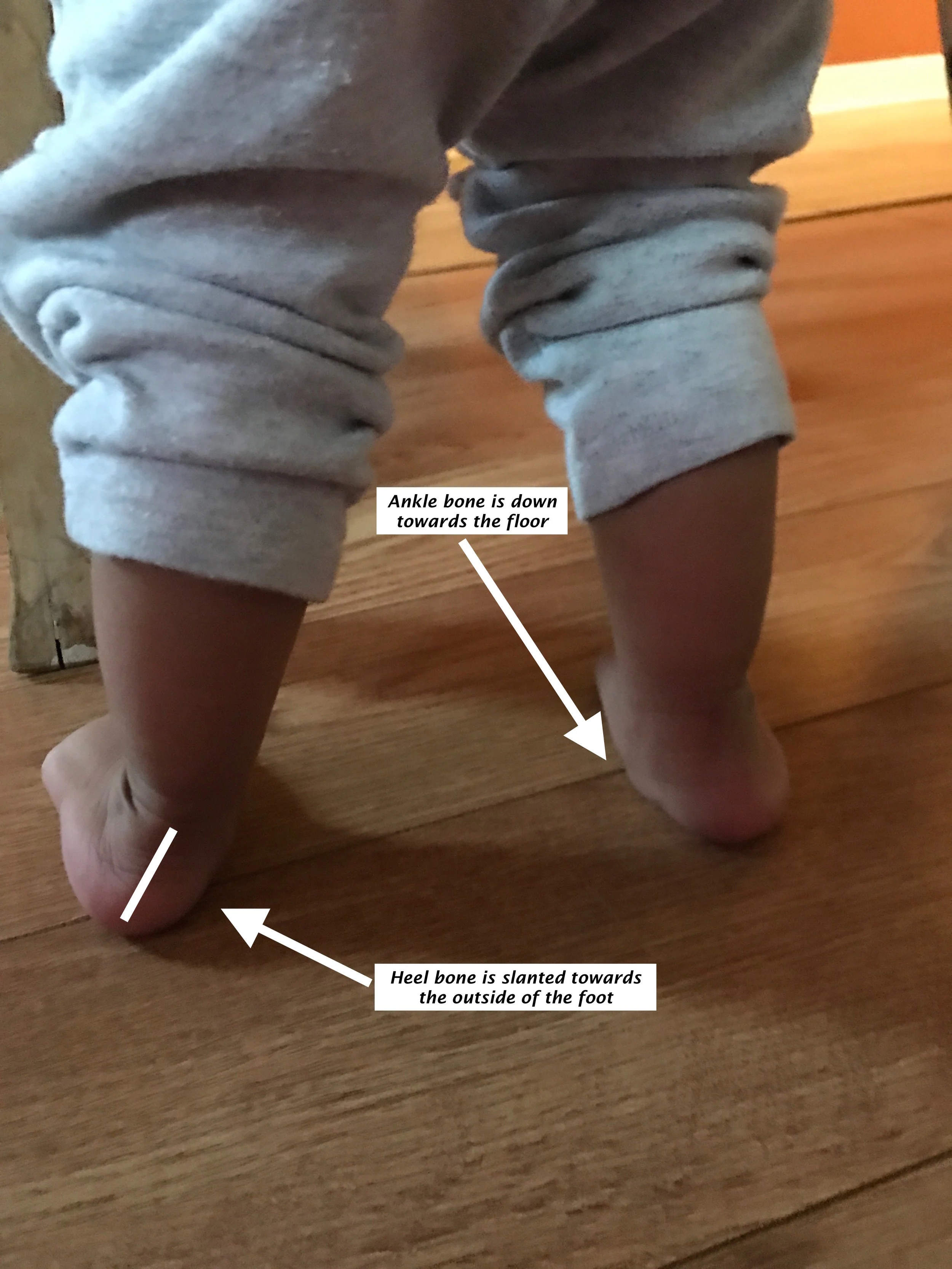 Flat feet in children thoughts from a PT — Gross Motor Mama
