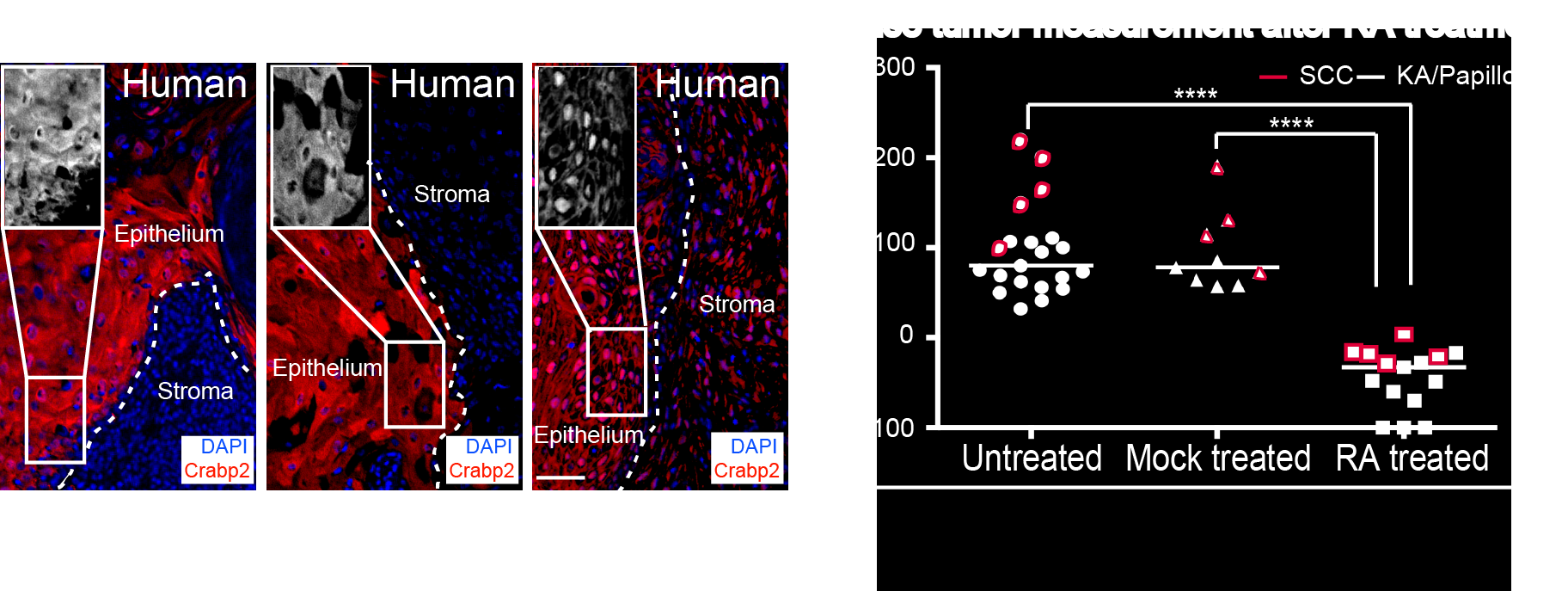 Figure 2. On the left, the Retinoic Acid (RA) pathway is activated during the regression of the human benign KA tumors as visualized by the nuclear localization of a RA component, Crabp2 (in red) in the IF stainings. On the right, RA treatment on both benign and malignant tumors lead to tumor regression.