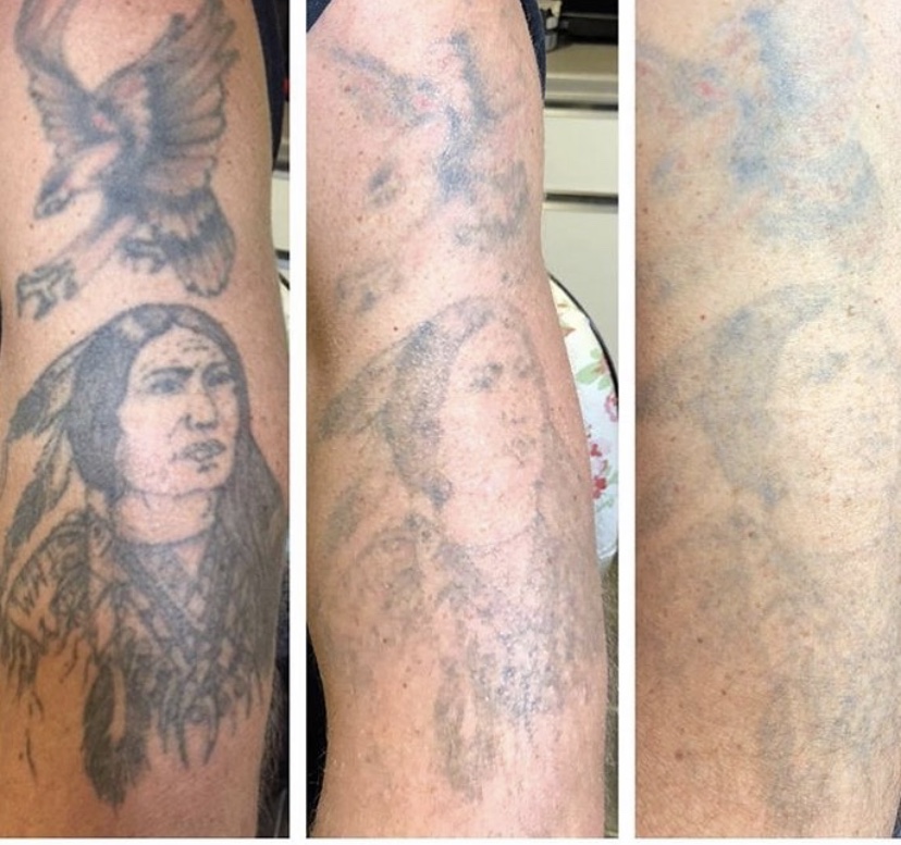 Laser Clinic — Real Art Tattoo