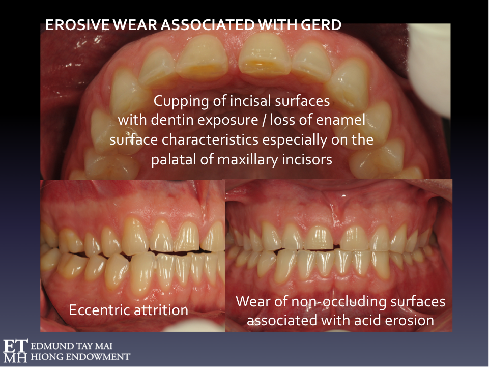 Bruxism phenotypes One size does not fit all! — Dental Sleep Medicine Singapore Edmund Tay