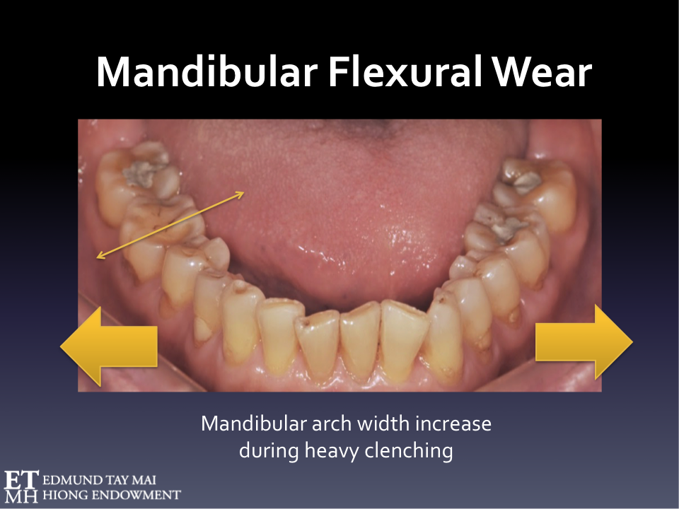 Awake Bruxism (AB) and the Masseter Muscle Hypertrophy Controversy; Secondary vs Primary(or