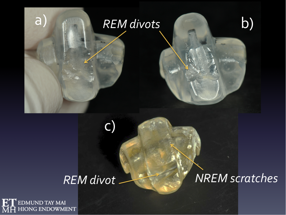 Establishing a putative diagnosis of bruxism in daily practice using a 6week NTI trial