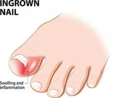 Ingrown Toenail — Amy Richardson, DPM - Redmond Foot & Ankle - Podiatrist