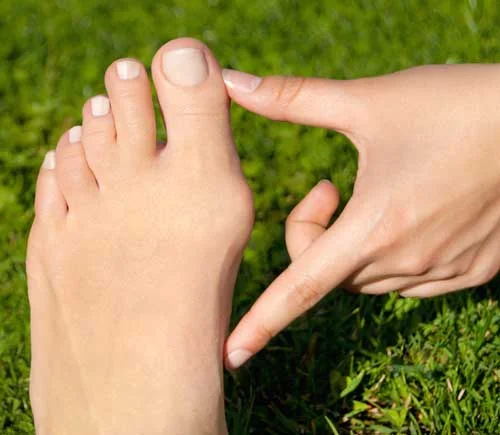 bunion.jpg