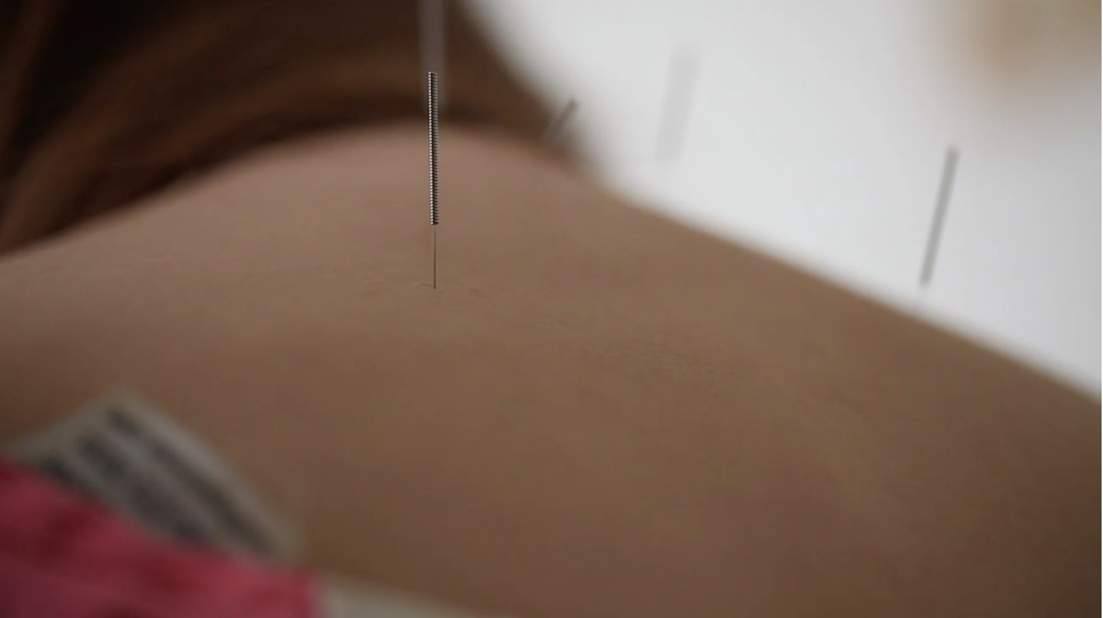 Explaining Acupuncture 