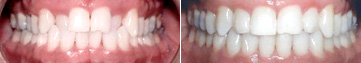 TEETH CROSSBITE