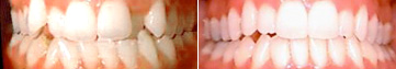 TEETH CROWDING