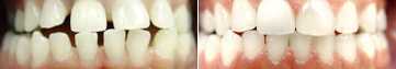GAPPED TEETH