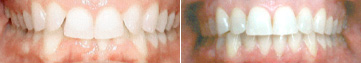 TEETH OVERBITE
