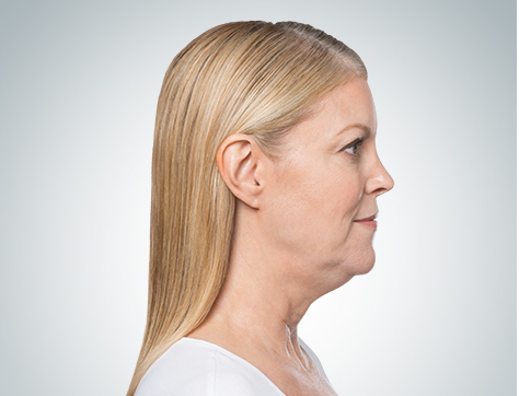 kybella right-before.jpg