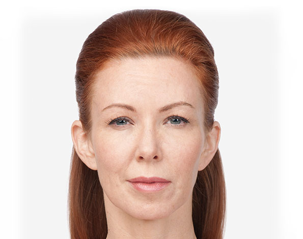 botox after 5.jpg