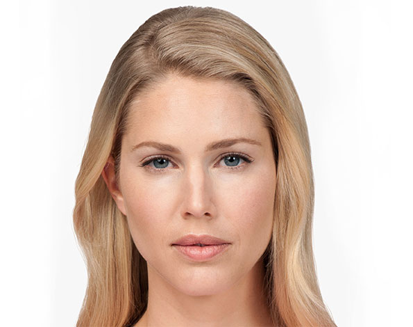 botox after.jpg