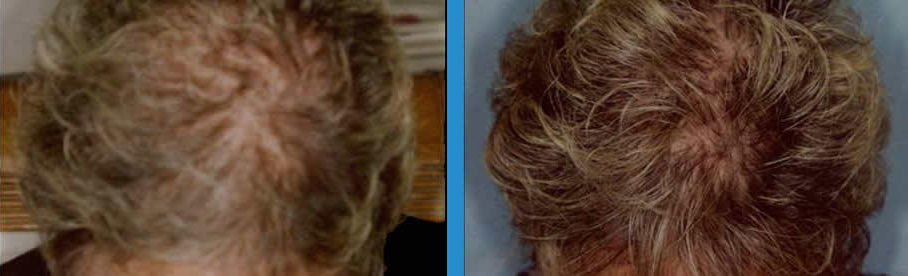 sunetics-ba-51-yrs-old-after-6-months.jpg