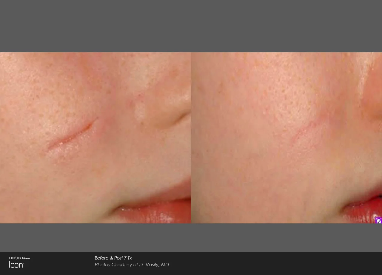 Icon-D-Vasily-surgicalscar-cheekpost7Tx.jpg