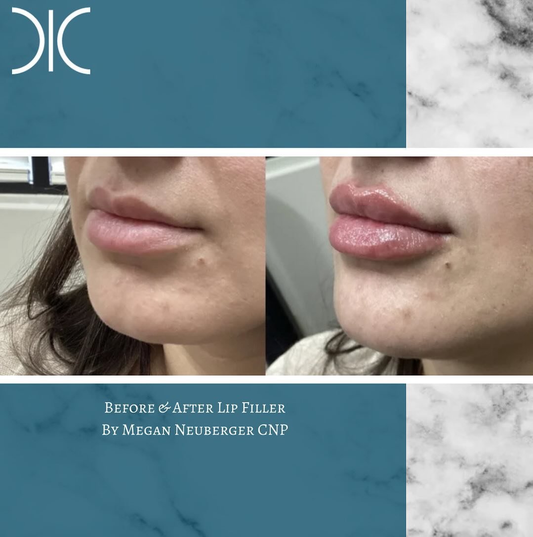 #beautiful #lippies by Megan! You can use our 40% off a single product or treatment toward #filler in #april ! #dontmissout #booknow ! 
☎️6145452002
💻www.monarch-aesthetic.com
#transformationtuesday #beforeandafter #results #lipfiller #lipfillerbefo