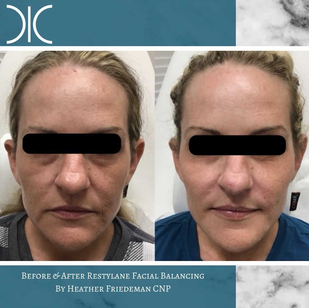 5 syringes of #restylane for this #gorgeous patients #beforeandafter ! #facialbalancing is the new #trend in #aesthetics , but we&rsquo;ve been using #filler for full face #volumerestoration and #natural #antiaging for years! #booknow and #turnbackti