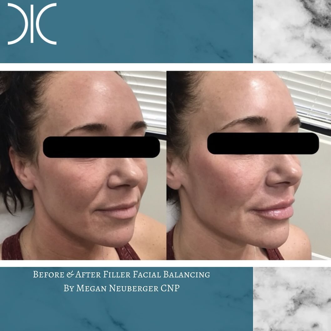 #gorgeous #natural and #rejuvenated ! #facialbalancing by Megan on this #beauty ! #booknow 
☎️6145452002
💻www.monarch-aesthetic.com
#filler #fillers #dermalfillers #dermalfiller #beforeandafter #beforeandafterfiller #restylane #juvederm #medspa #med