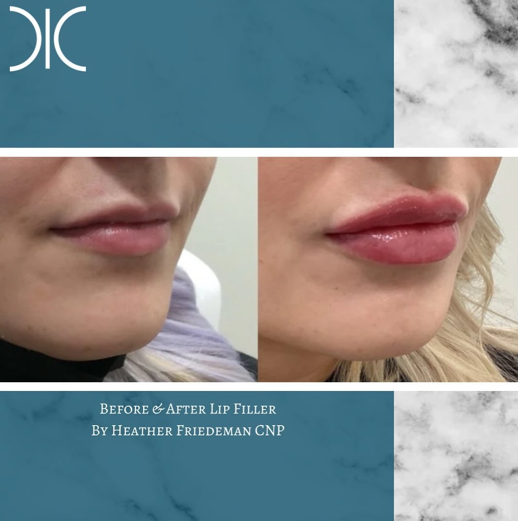 The #perfectlips do exist! #obsessed #booknow 
☎️6145452002
💻www.monarch-aesthetic.com
#transformationtuesday #beforeandafter #filler #fillers #lipfiller #lipfillerbeforeandafter #medspa #medspalife #medspamagic #columbusmedspa #cbusmedspa #asseenin