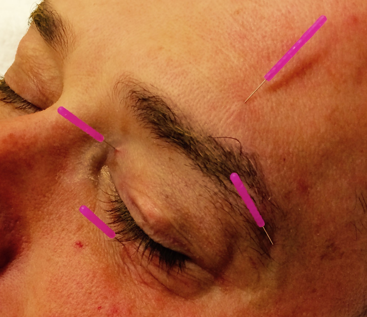 Acupuncture needle treatment