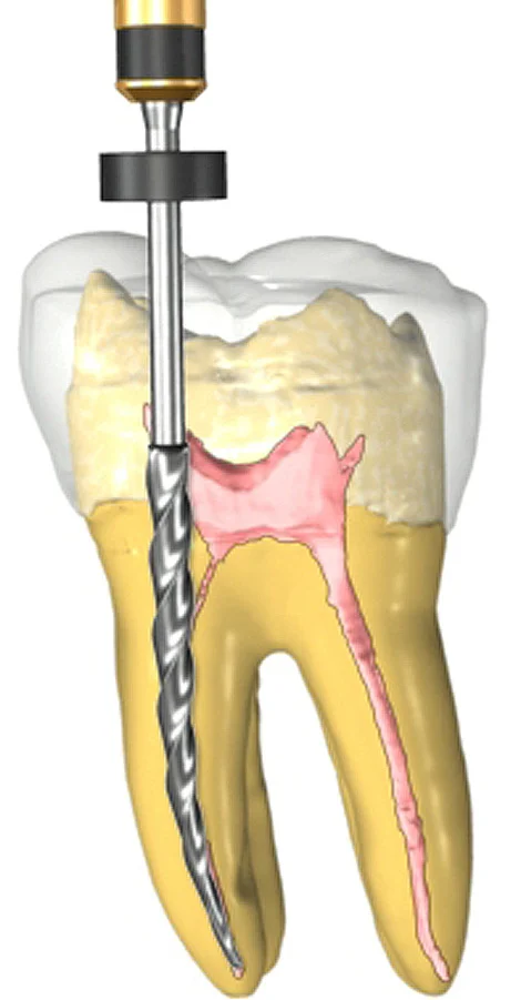 root-canal-470.jpg
